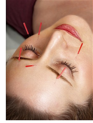 acupuncture facelift Chichester West Sussex